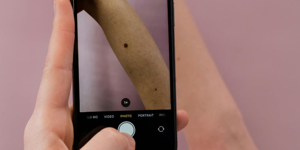 mole on arm from pexels by cottonbro studios
